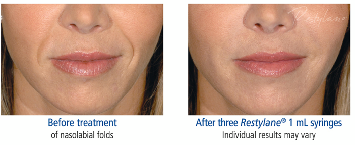 Restylane