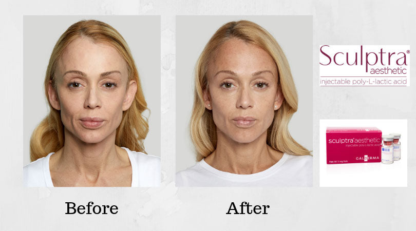 Sculptra Sale!