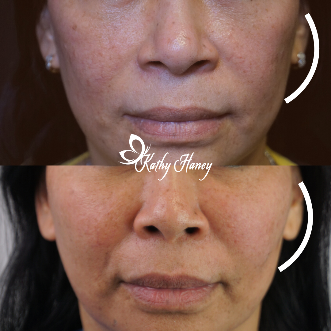 Restylane Lyft