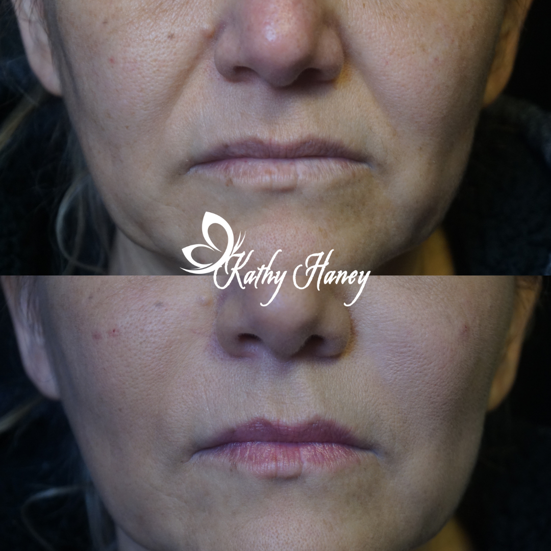 Restylane