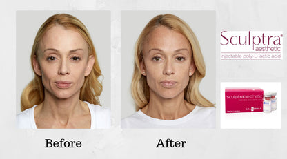 Sculptra Sale!