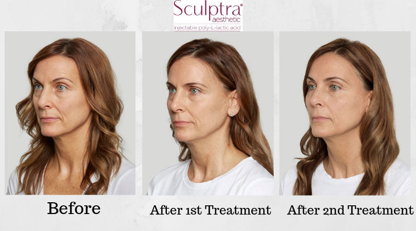 Sculptra Sale!
