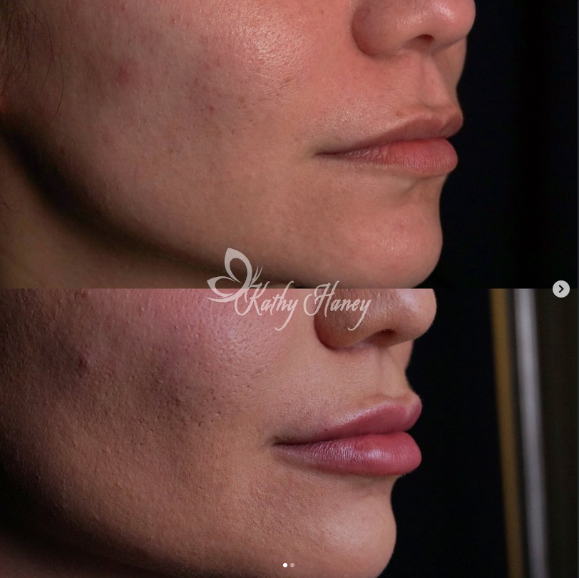Before and After of lips using Restalyne at Transformation Medispa, Houston Texas