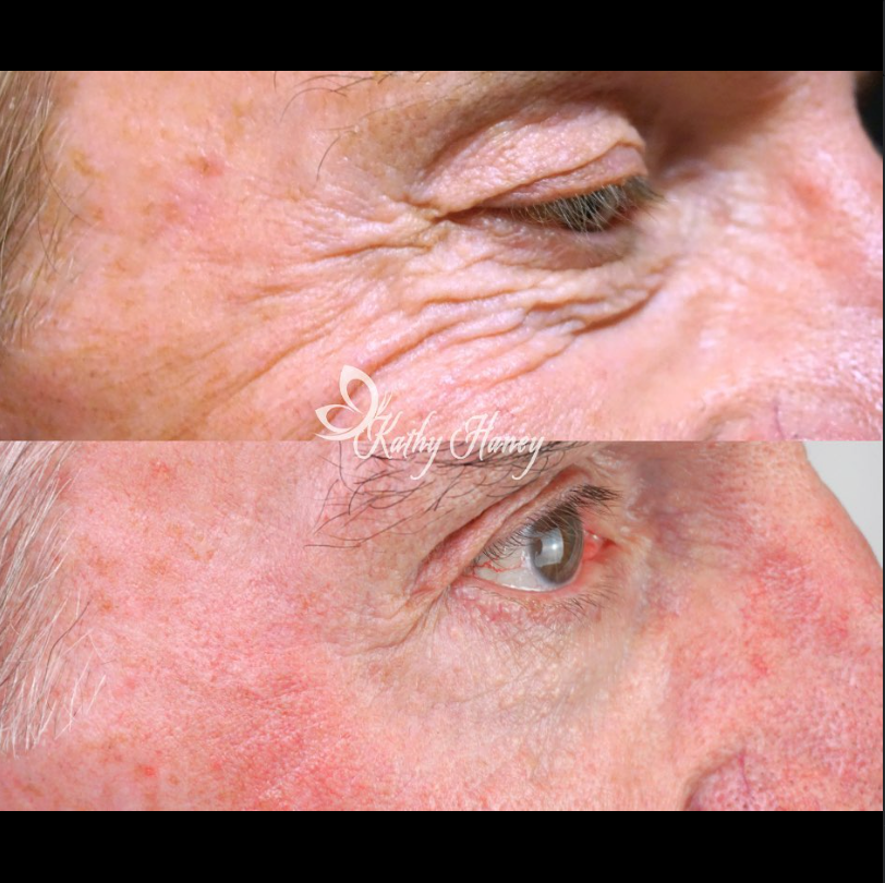 Eye improvements at Transformation Medispa, Houston Texas