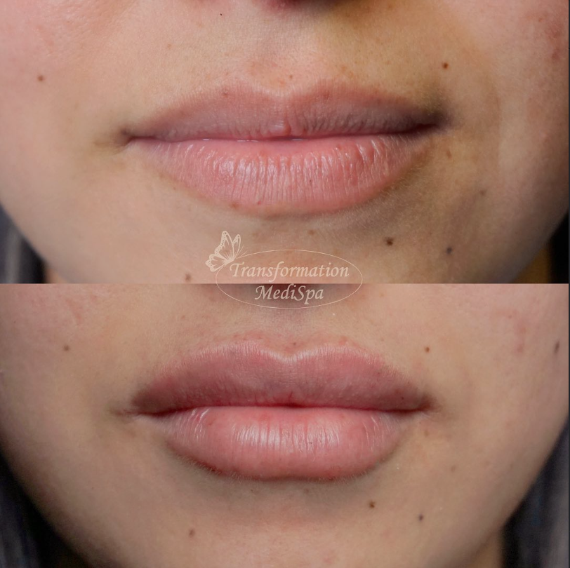 Before and after comparison of lips at Transformation MediSpa. using Radiesse. Houston Texas